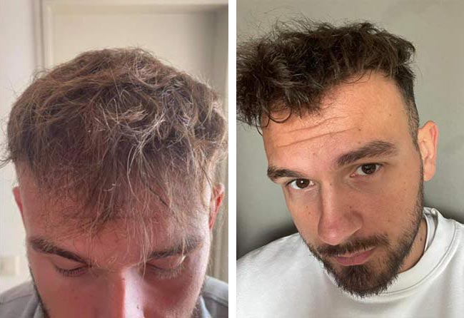 نتائج عملية زراعة الشعر للسيد سيفكيت | اليت هير