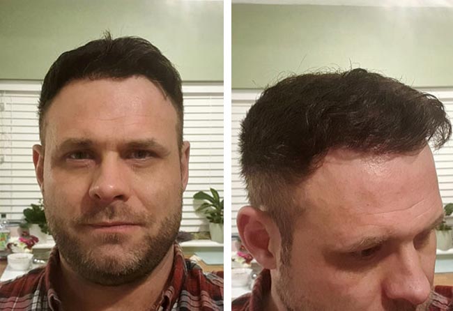 نتائج عملية زراعة الشعر للسيد مايكل | اليت هير