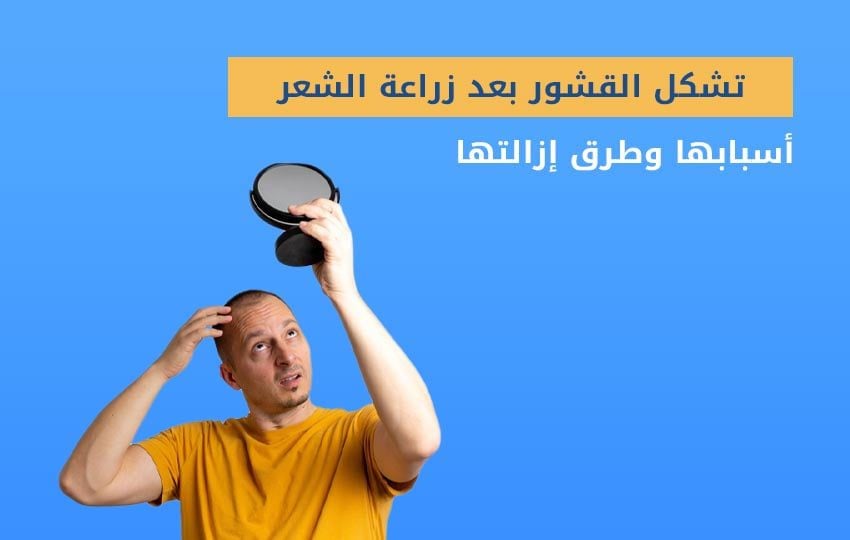 تشكل القشور بعد إجراء زراعة الشعر في تركيا