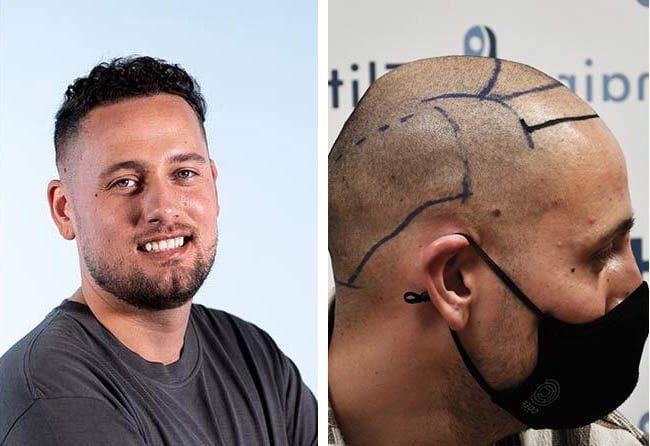 زراعة شعر قبل وبعد للسيد منير مركز اليت هير