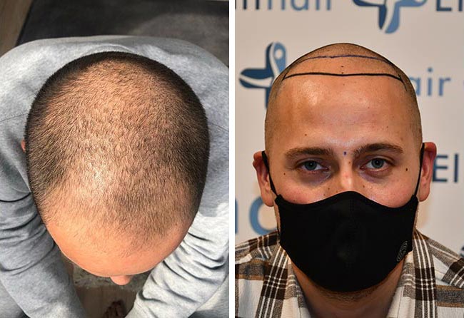 قبل زراعة شعر للسيد منير مركز اليت هير