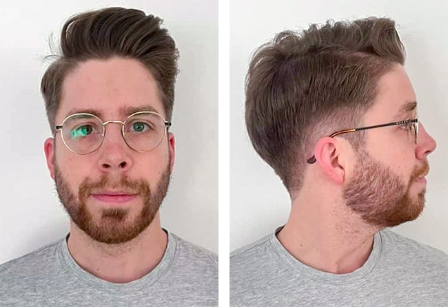 نتائج زراعة شعر للسيد إيكي مركز اليت هير