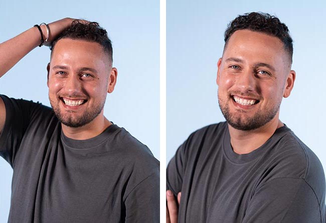 نتائج زراعة شعر للسيد منير مركز اليت هير
