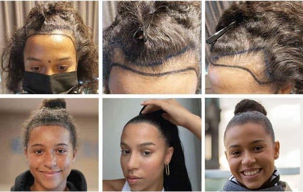  زراعة الشعر قبل وبعد للآنسة ميليسا 2700 بصيلة