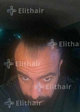 أحمد الغطاس قبل-زراعة-الشعر-في-مركز-اليت-هير