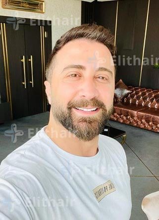 الفنان عبد الكريم حمدان بعد-زراعة-الشعر-في-مركز-اليت-هير jpg