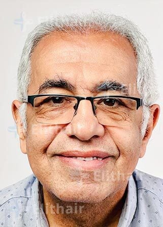 عاطف لاوندي-بعد-4 شهور-زراعة-الشعر-في-مركز-اليت-هير