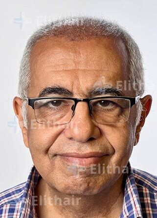 عاطف لاوندي-قبل-زراعة-الشعر-في-مركز-اليت-هير