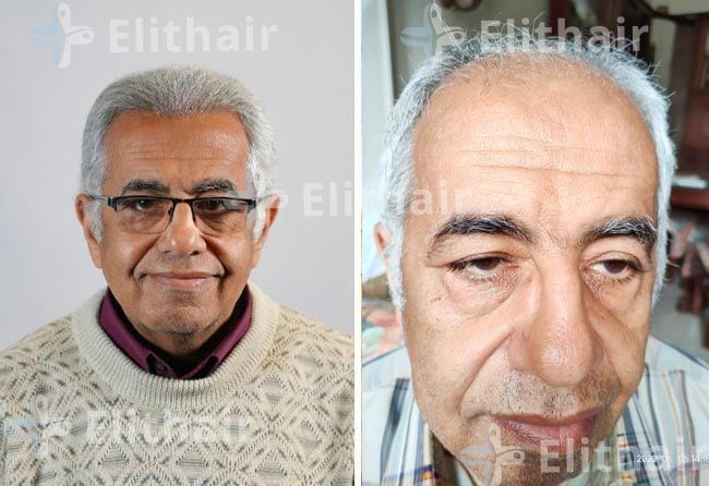 عاطف لاوندي-قبل-وبعد-زراعة-الشعر-في-مركز-اليت-هير