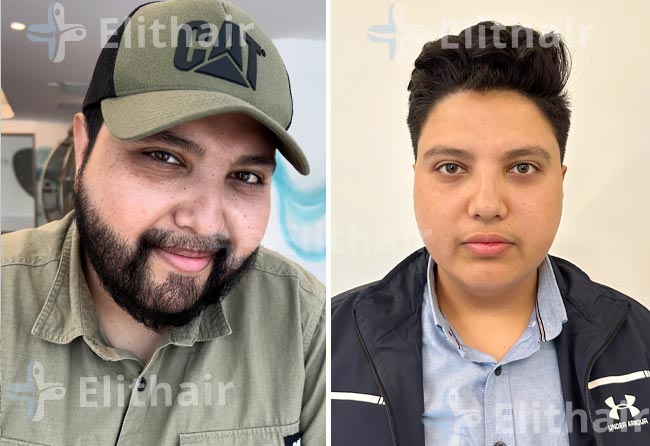 محمد اسكندر قبل-وبعد-زراعة-اللحية-في-مركز-اليت-هير
