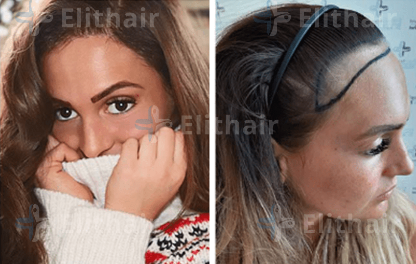 زراعة الشعر للآنسة كارين - مركز اليت هير لزراعة الشعر