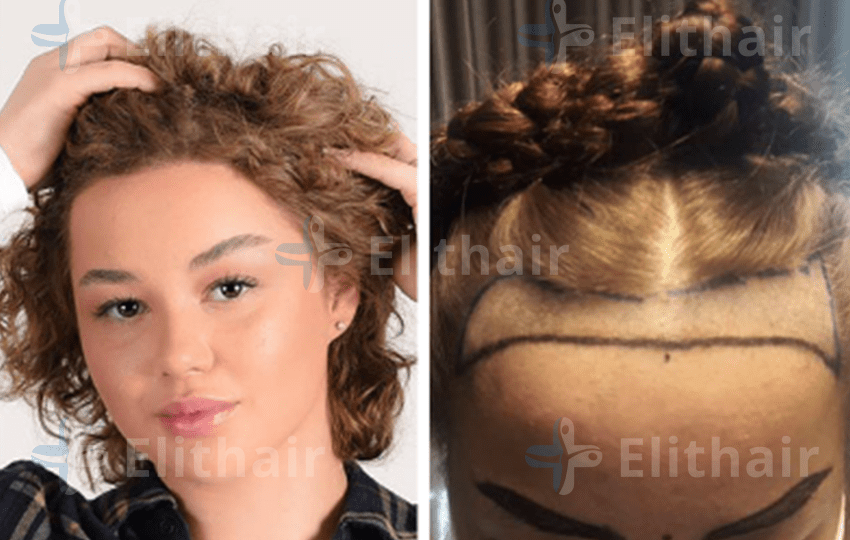 زراعة الشعر للآنسة ليليانا - مركز اليت هير لزراعة الشعر