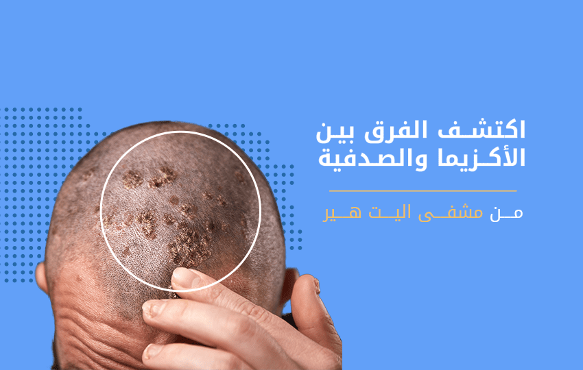 ما هو الفرق بين الاكزيما والصدفية وكيف يمكن علاجهما