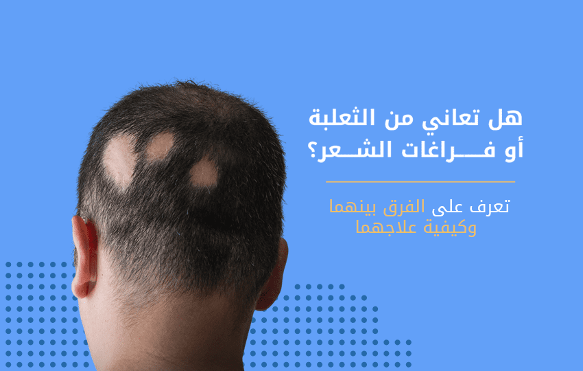ما هو الفرق بين الثعلبة وفراغات الشعر