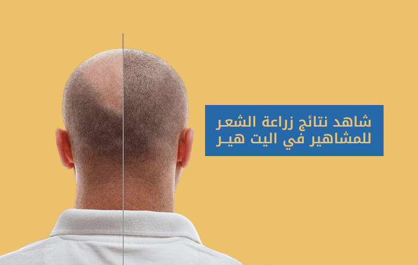 نتائج زراعة الشعر قبل وبعد في تركيا