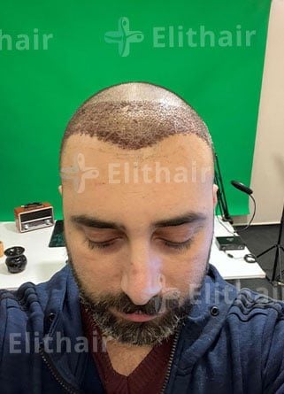 زراعة الشعر لأحمد الصادق في مركز اليت هير