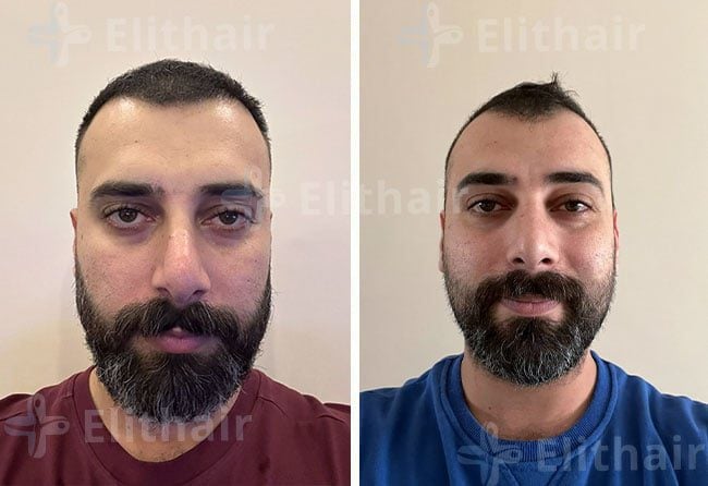 أحمد الصادق قبل وبعد زراعة الشعر في مركز زراعة الشعر