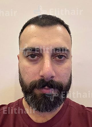 احمد صادق نتائج زراعة الشعر في مركز زراعة الشعر