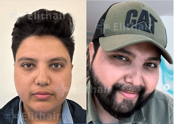 قبل وبعد زراعة شعر اللحية لأحد المرضى في أليت هير