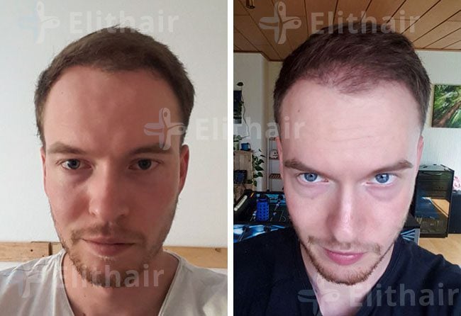 بعد 4 شهور من زراعة الشعر للسيد لوكاس في مركز اليت هير
