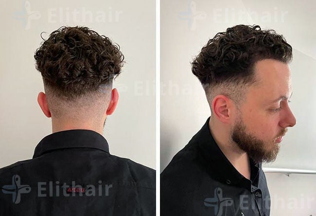 بعد 6 شهور من زراعة الشعر