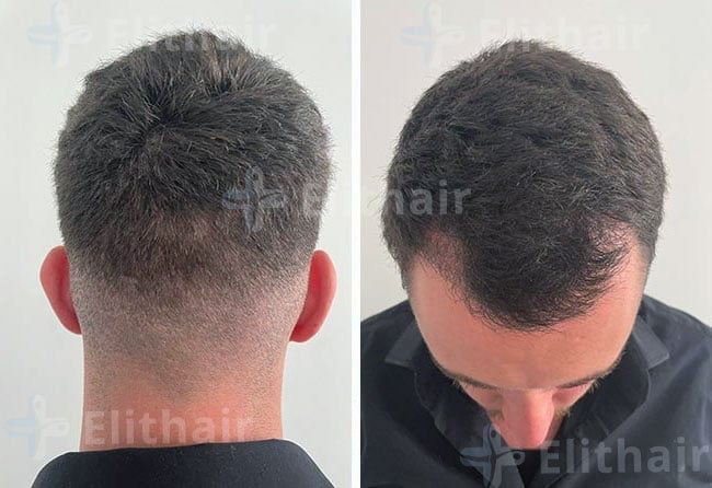 بعد شهرين زراعة الشعر في مركز اليت هير