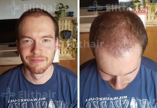 بعد شهرين من زراعة الشعر للسيد لوكاس في مركز اليت هير