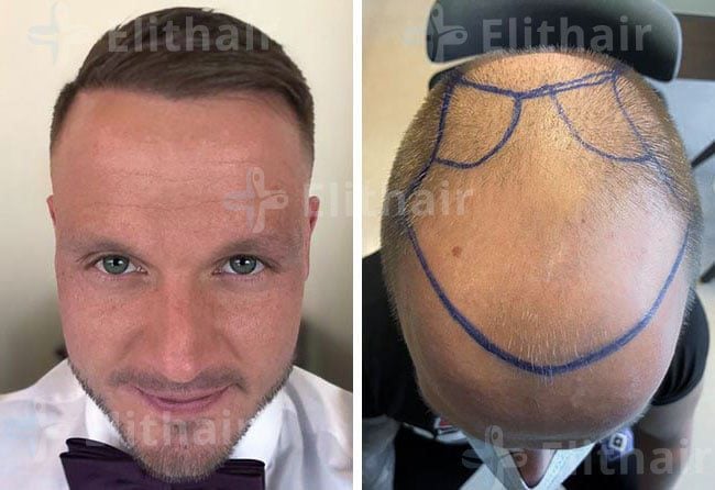 زراعة الشعر قبل وبعد في مركز اليت هير