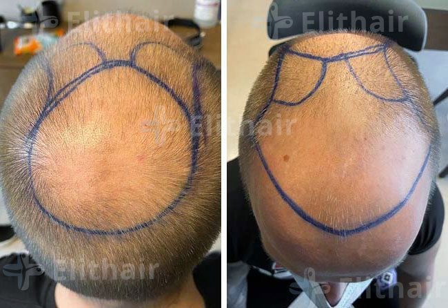قبل زراعة الشعر في مركز اليت هير