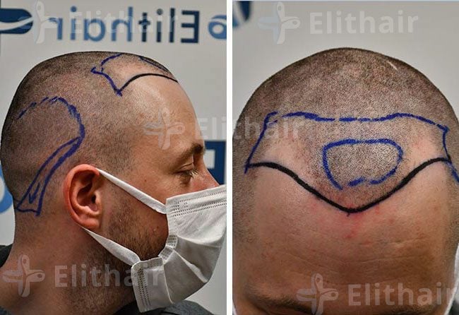 قبل زراعة الشعر في مركز اليت هير