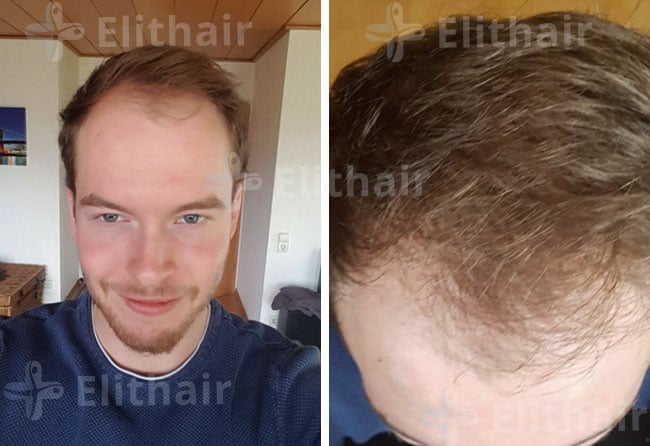 قبل زراعة الشعر للسيد لوكاس في مركز اليت هير