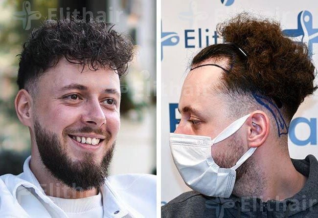 نتائج زراعة الشعر في مركز اليت هير
