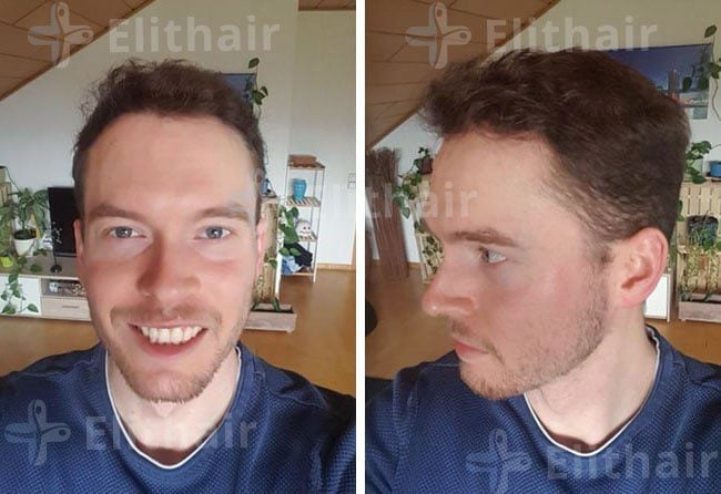 نتائج زراعة الشعر للسيد لوكاس في مركز اليت هير