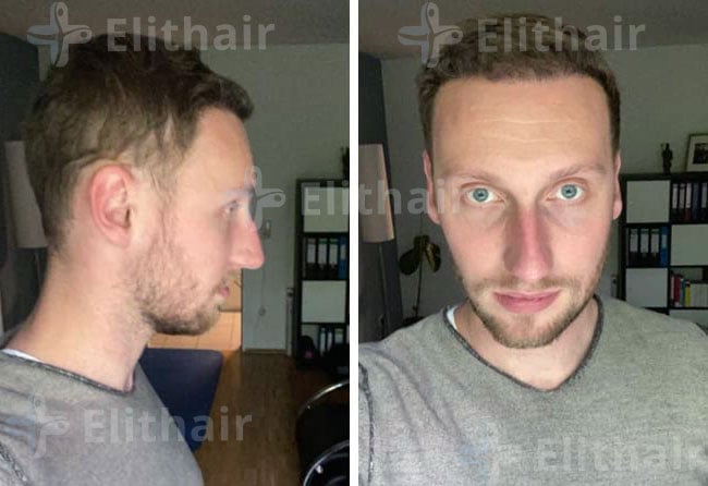 بعد 4 اشهر زراعة الشعر للسيد أوليفر 3950 بصيلة