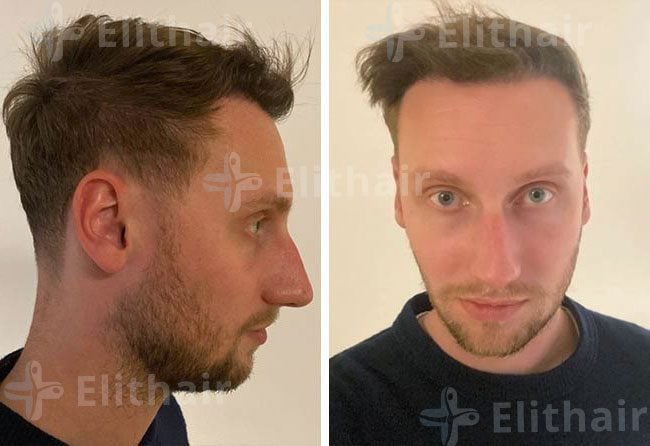بعد 6 اشهر زراعة الشعر للسيد أوليفر 3950 بصيلة