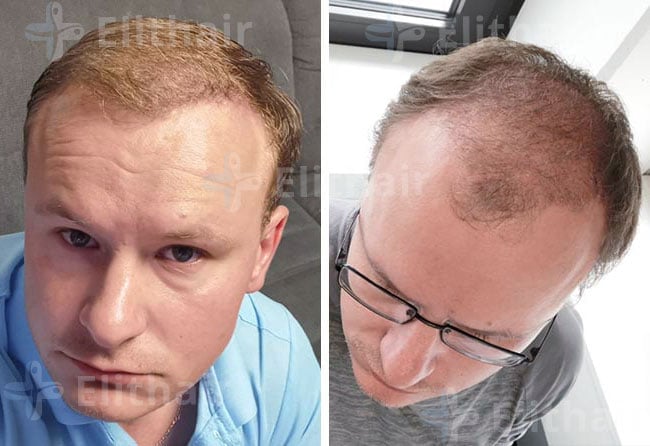 بعد 6 شهور من زراعة الشعر 4200 بصيلة في مركز اليت هير