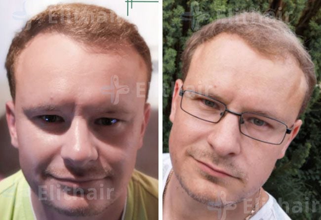 بعد 8 شهور من زراعة الشعر 4200 بصيلة في مركز اليت هير