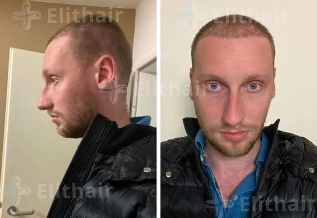 بعد شهرين زراعة الشعر للسيد أوليفر 3950 بصيلة