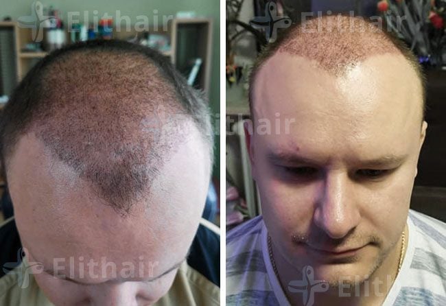 بعد شهرين من زراعة الشعر 4200 بصيلة في مركز اليت هير