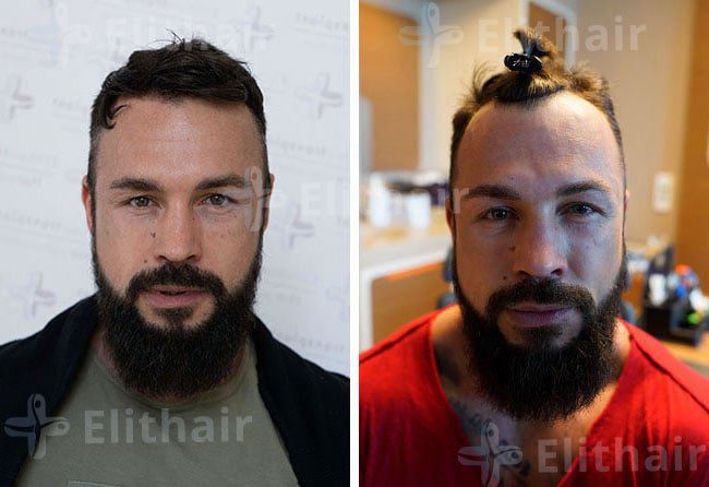 زراعة الشعر في مركز اليت هير 2200 بصيلة