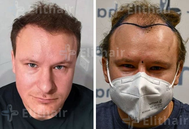 زراعة الشعر قبل وبعد 4200 بصيلة في مركز اليت هير
