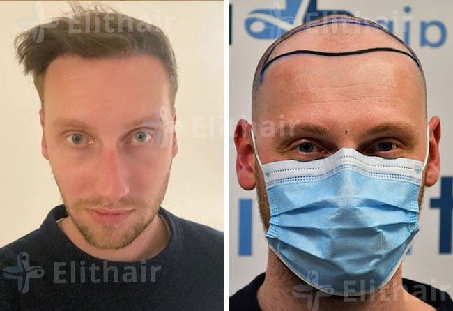 زراعة الشعر قبل وبعد للسيد اوليفر 3950 بصيلة