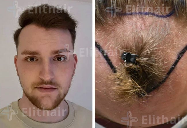 زراعة الشعر قبل وبعد للسيد مارك في مركز اليت هير
