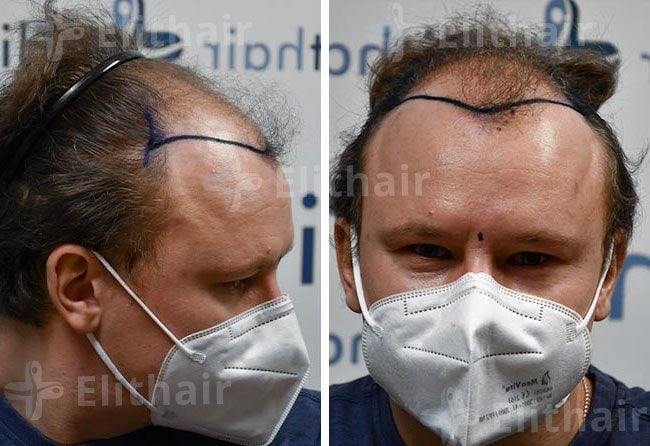 قبل زراعة الشعر 4200 بصيلة في مركز اليت هير