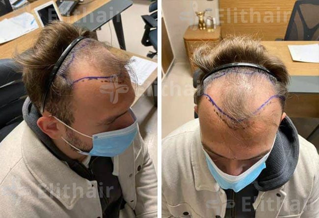 قبل زراعة الشعر 4500 بصيلة قي مركز اليت هير
