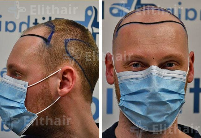 قبل زراعة الشعر للسيد أوليفر 3950 بصيلة