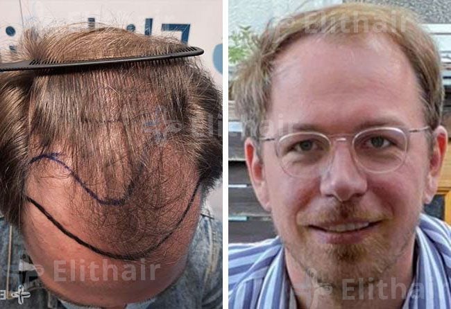 قبل زراعة الشعر للسيد توبايس