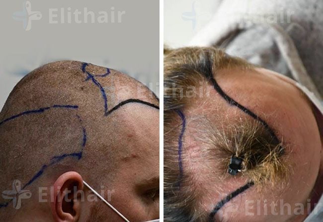 قبل زراعة الشعر للسيد مارك في مركز اليت هير