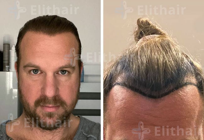 قبل وبعد زراعة الشعر في مركز اليت هير