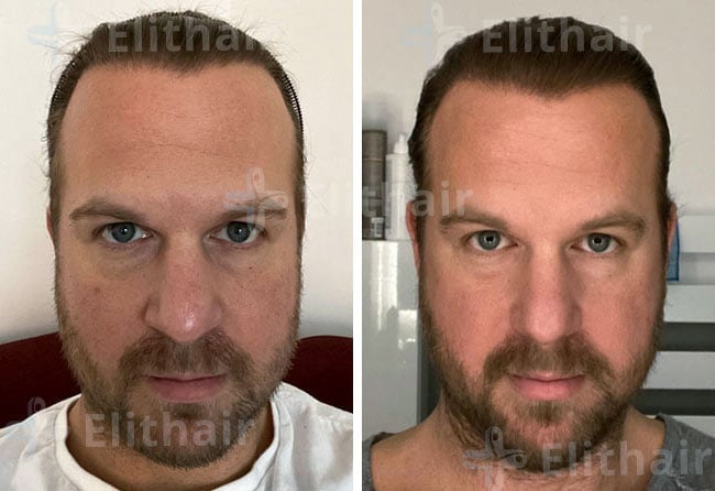 نتائج زراعة الشعر في أفضل مركز زراعة الشعر اليت هير